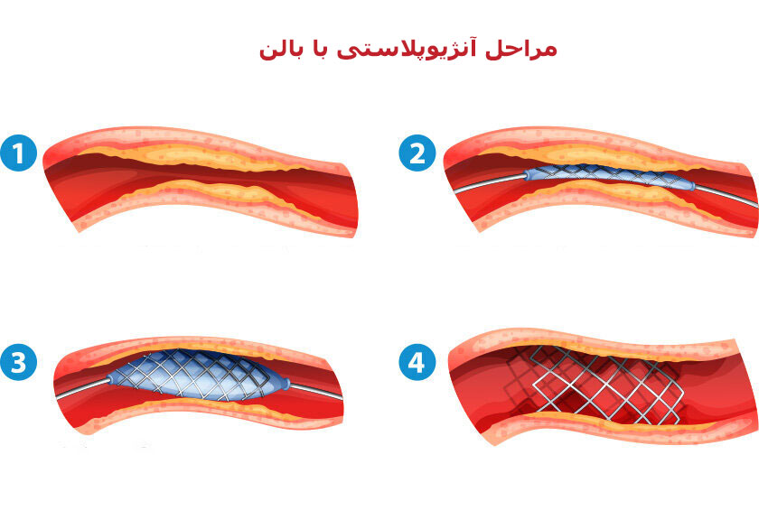 مراحل بالن زدن قلب