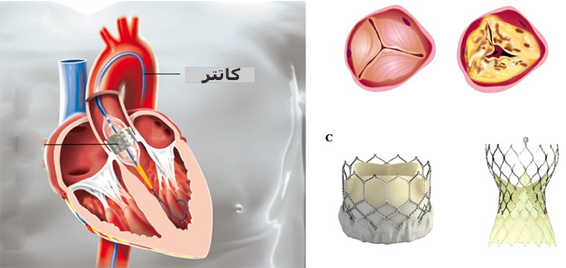مراحل عمل تاوی قلب