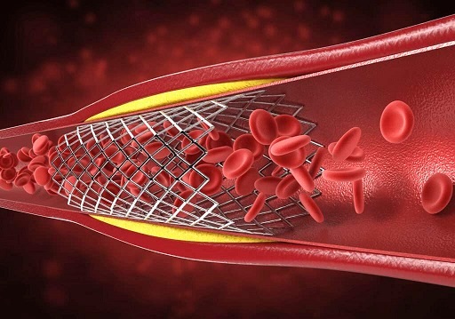 باز کردن رگ با روش آنژیوپلاستی