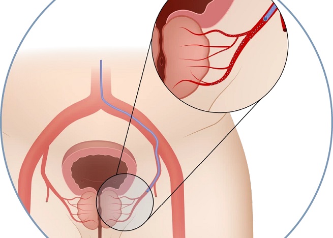 PAE، یک روش درمانی کم ‌تهاجمی است که با هدف کوچک کردن پروستات
