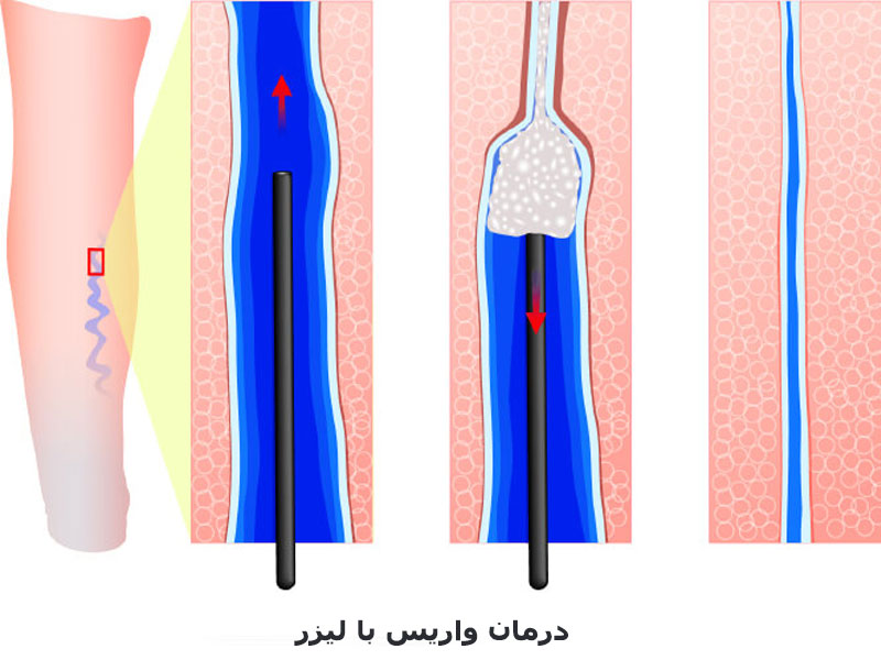 درمان واریس با لیزر