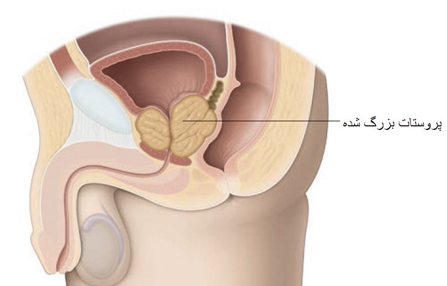 پروستات بزرگ شده و جراحی